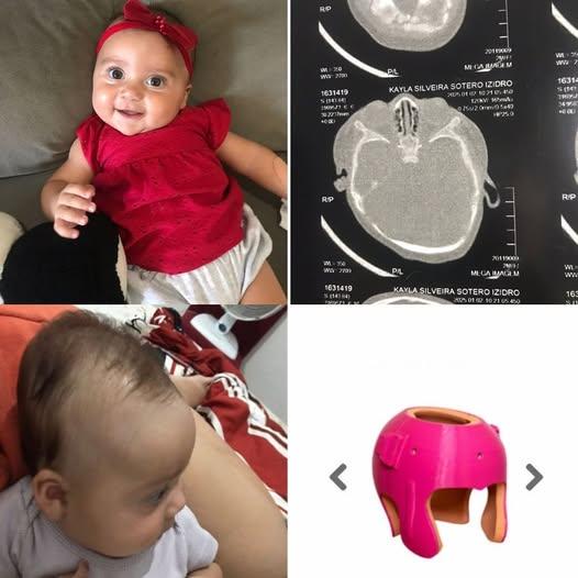 Bebê de Guarujá precisa de R$ 20 mil para tratar deformidade craniana com capacetinho especial