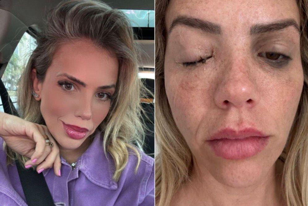 Apresentadora é infectada por bactéria com poder de cegar; conheça a celulite ocular