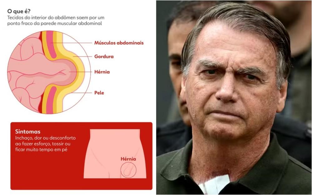 Bolsonaro já está no quarto e cirurgia não teve intercorrências, dizem médicos
