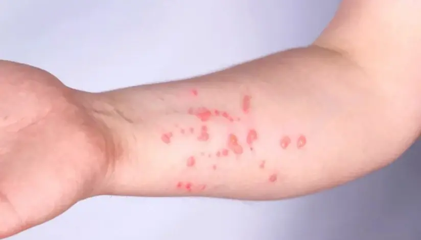 Mongaguá notifica dois casos suspeitos de mpox; um paciente é transferido para hospital de referência