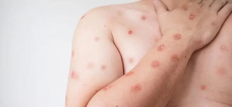 Santos confirma dois casos de mpox em 2026; Estado soma 44 registros neste ano